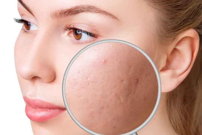 کرم ضد جوش و جای جوش صورت و بدن